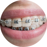 Braces